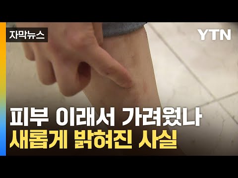 [자막뉴스] '원인 불명' 가려움증...수수께끼 퍼즐 풀렸다 / YTN