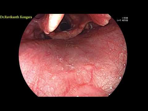 ENDOSCOPY PROCEDURE  EXPLAINED BY DR RAVIKANTH KONGARA