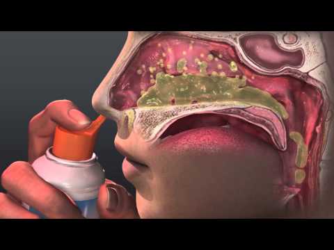 Can Saline Irrigation Help Nasal Allergies? Animated Guide to Saline Nasal Irrigation.