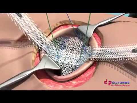 UCMC ClearMesh Composite - Umbilical Hernia Repair