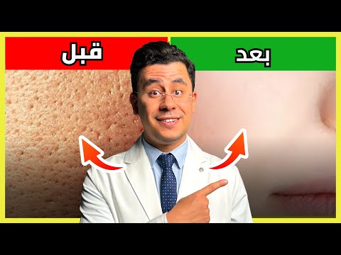 اقوى وصفة في العالم لعلاج المسام الواسعة !