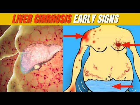 Early Signs of liver cirrhosis Signs You Can't Ignore for Better Health