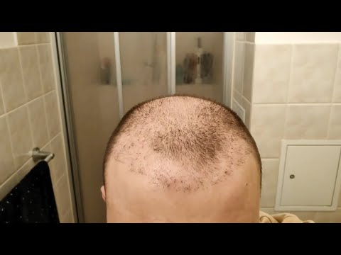 I Stopped Taking Finasteride after Hair Transplant | 1 Year Hair Loss Experiment