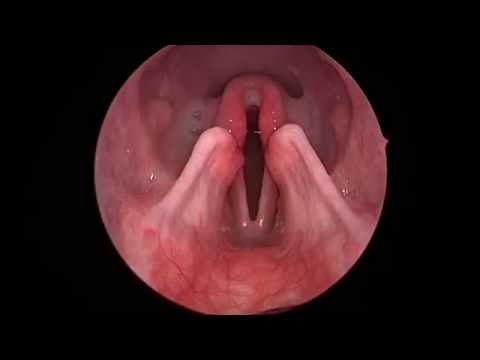 Dog: Lar Par (Laryngeal paralysis observed in sedated canine oral exam)