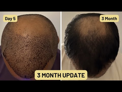 3 Month Update for Hair Transplant | 5200 grafts from Istanbul Turkey