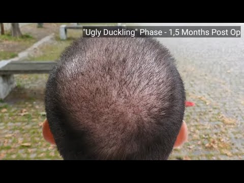 Hair Transplant Results After 9 Months  | Before &amp; After