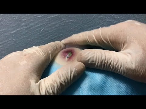 Big Cystic Acne Blackheads Extraction Blackheads &amp; Milia, Whiteheads Removal Pimple Popping