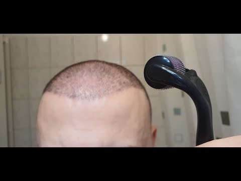 Minoxidil &amp; Dermarolling Results 6 MONTHS | Month by Month Progress