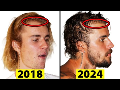 Did Justin Bieber Have a Hair Transplant?