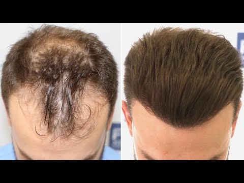 FUE Hair Transplant (3052 Grafts NW III-VI Vertex) By Dr Juan Couto - FUEXPERT CLINIC, Madrid, Spain