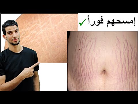 وداعا علامات التمدد والخطوط الحمراء والبيضاء  stretch marks