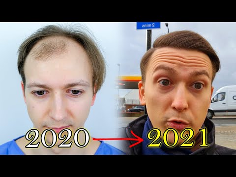 FUE Hair Transplant Growth Timeline | Before &amp; After