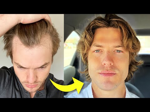 My Turkey Hair Transplant Results After 1 Year | Before &amp; After