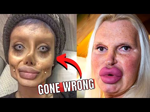 7 Times Plastic Surgery Went Horribly Wrong | Biggest Plastic Surgery Fails