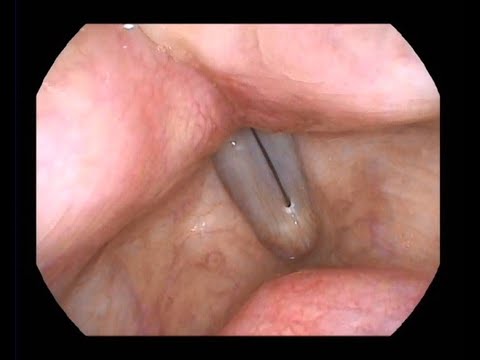 Mucosal Waves of The Vocal Cord on Phonation