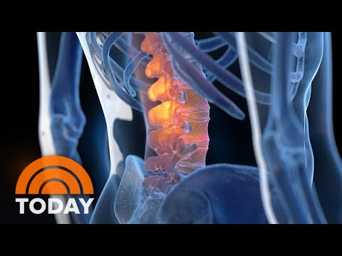 New therapy aims to cure back pain without drugs, surgery