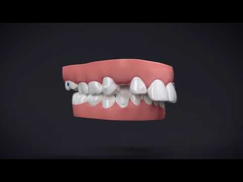 Invisalign&reg; Treatment with Manidublar Advancement