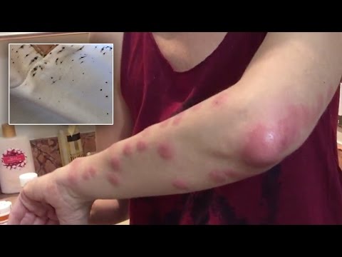 Woman Severely Bitten By Bedbugs At Atlantis Paradise Island Sues Resort