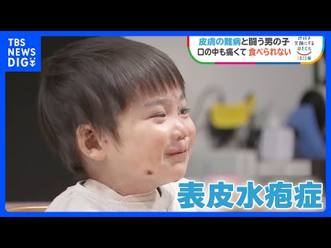 皮膚の難病の子どもたちに&ldquo;おいしい栄養&rdquo;&nbsp;「世界一やさしいチョコレート」【SDGｓ】｜TBS&nbsp;NEWS&nbsp;DIG