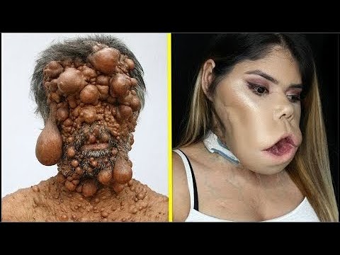 15 Real People With Extremely Weird Diseases