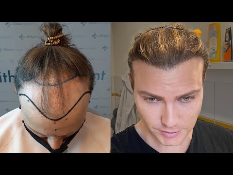 Hair Transplant in Timelapse - Before After Result