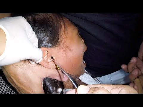 Removing Something Trapped in Girl's Ear . It's STUCK!