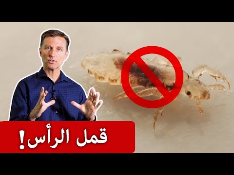 أفضل علاج منزلي لقمل الرأس!