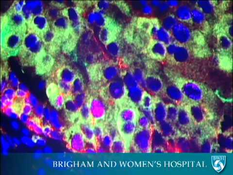 Nanoparticles for Cancer Treatment Video - Brigham and Women's Hospital