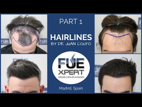 HAIRLINES by Dr Juan Couto at FUExpert Clinic - Hair Transplant Clinic in Madrid, Spain - PART 1