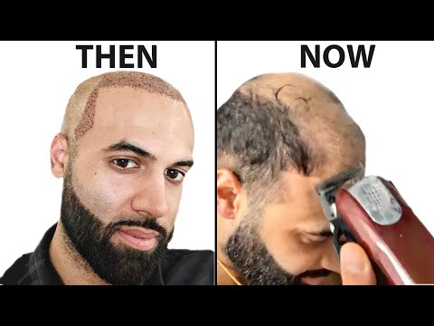 I Shaved My HEAD BALD 4 Years After Hair Transplant | Surgeon Reacts