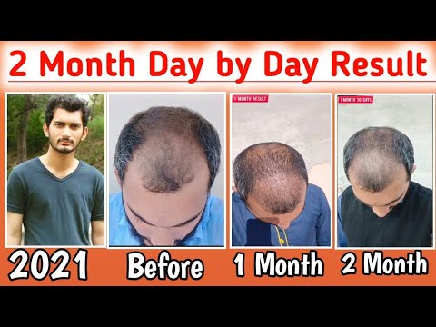 Before and after Condition 2 Month Complete day 1 to day 60 Hair Transplant Result 2 month complete