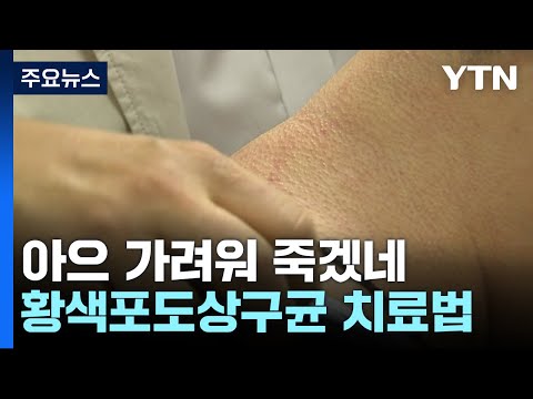 식중독 일으키는 황색포도상구균이 피부 가려움도 유발!...치료법도 발견 / YTN