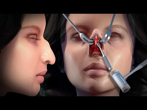 Rhinoplasty (Nose Job) | Step by step