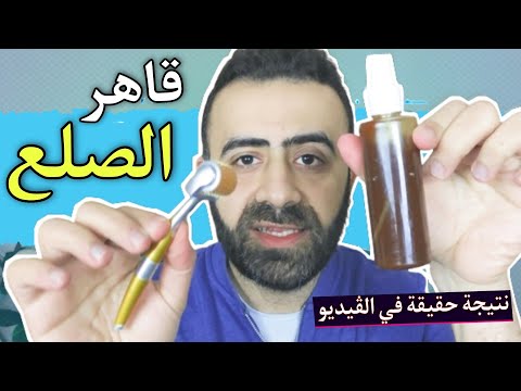 علاج مجرب للصلع و انبات فراغات الشعر طبيعي و بدون زيوت - و النتيجة في الڤيديو تشهد 👆