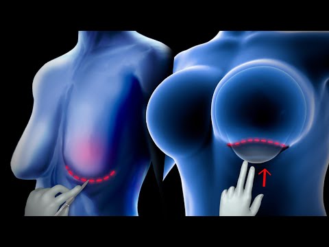 How breast enlargement surgery is carried out