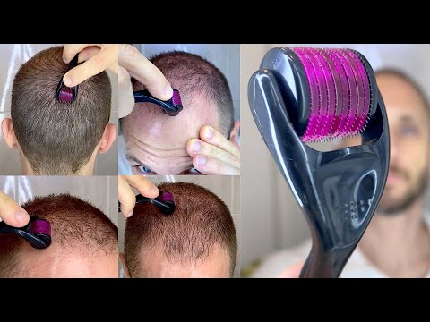 How I Use DermaRoller for Hair Growth and To Solve my Baldness and Hair Loss Tutorial 4k